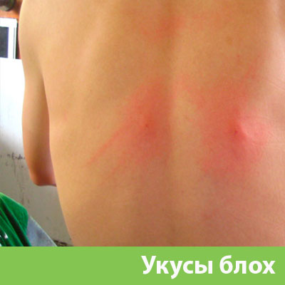 Укусы блох в Димитровграде
