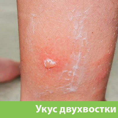 Укус двухвостки в Димитровграде