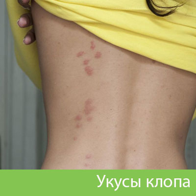 Профессиональное уничтожение клопов в Димитровграде